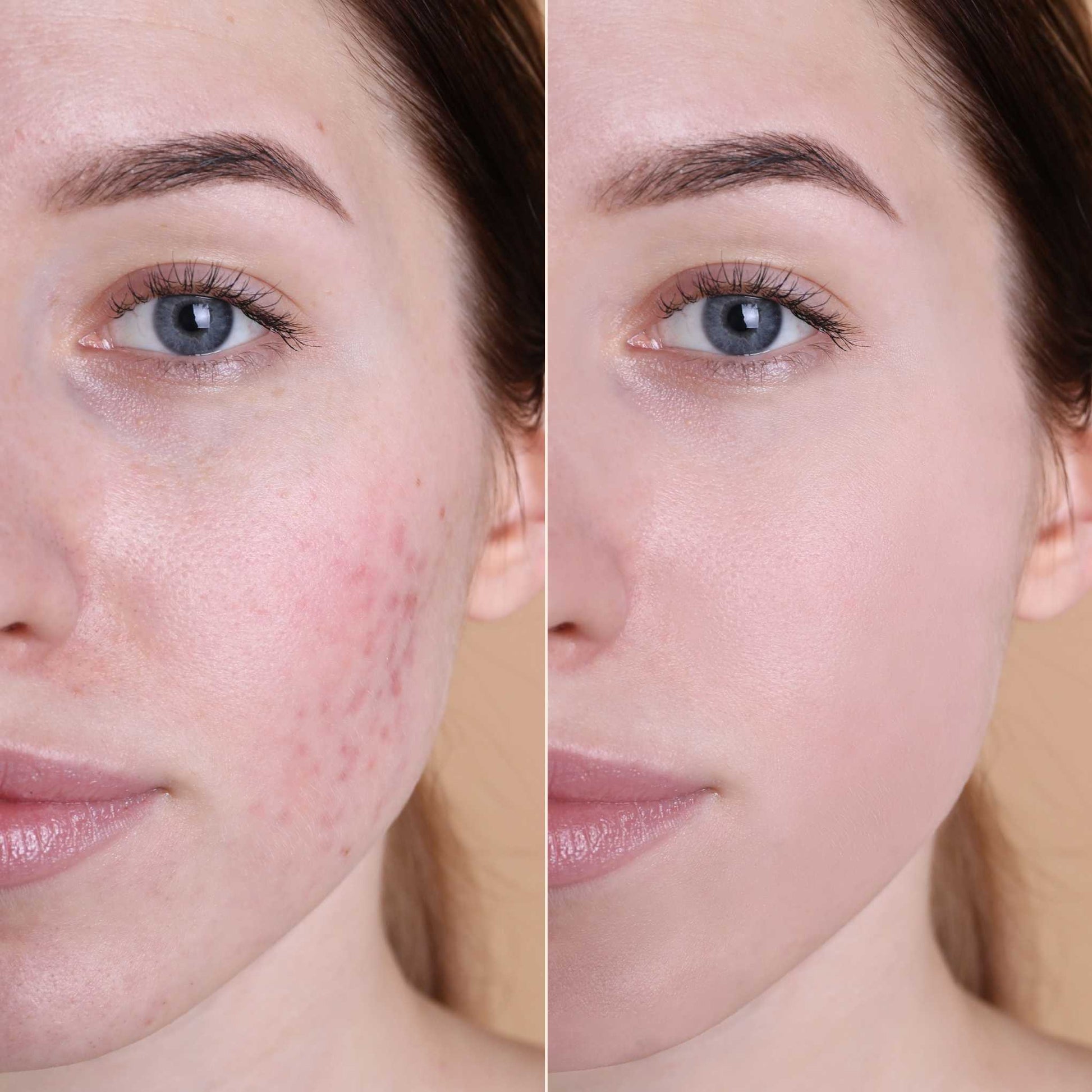 Before and after effect of Oplenza Natural Finish Cream Concealer on a model