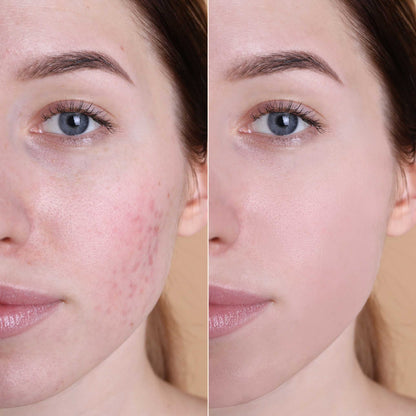 Before and after effect of Oplenza Natural Finish Cream Concealer on a model