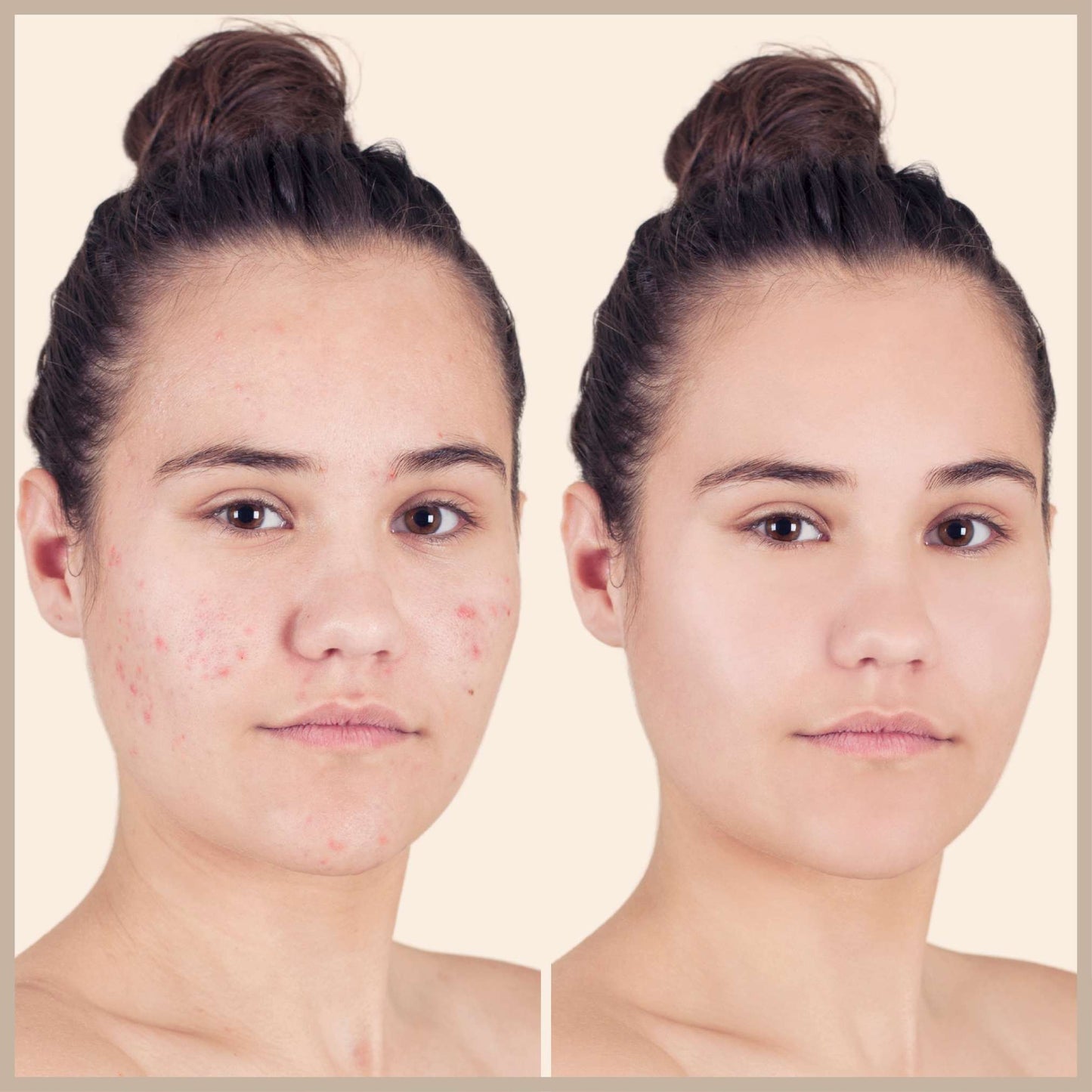 Before and After effect of Oplenza Opulent Concealer Palette - best concealer palette for red dots